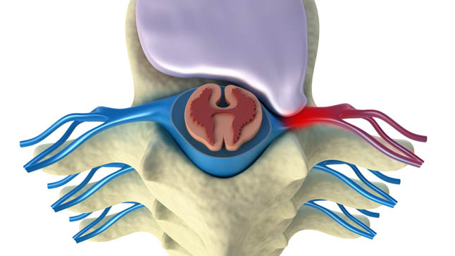 Hernia discal