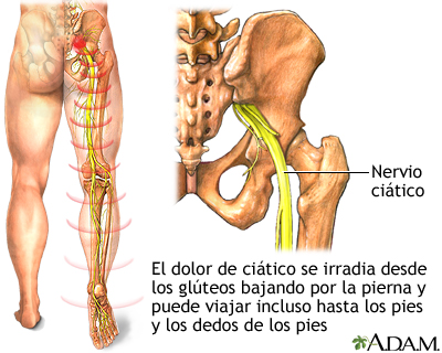 Hernia discal